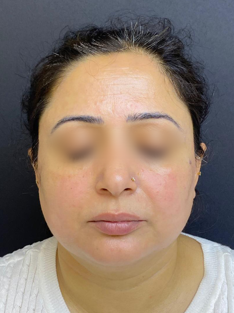 Before treatment